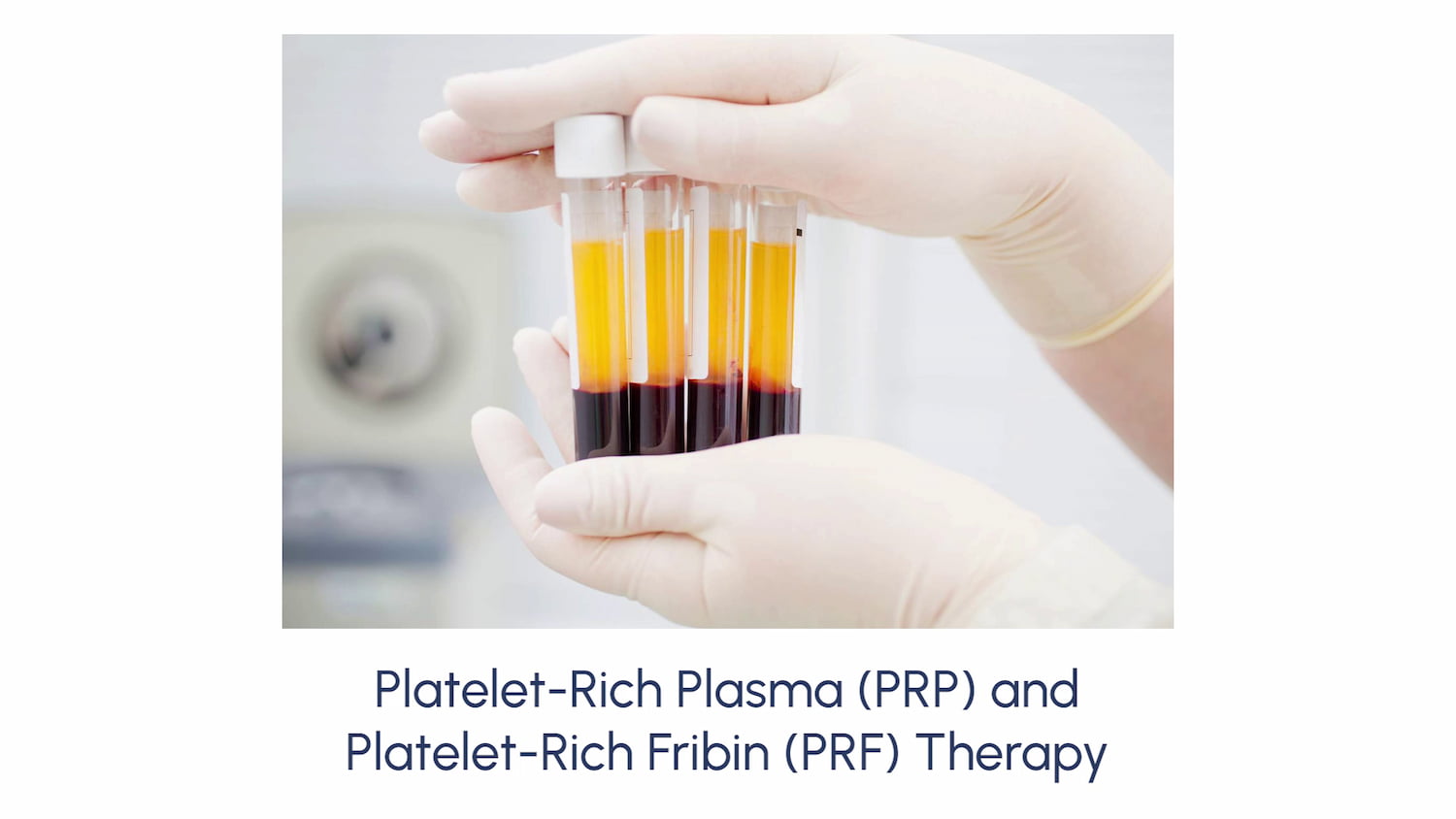 Platelet-Rich Plasma (PRP) And Platelet-Rich Fribin (PRF) Therapy