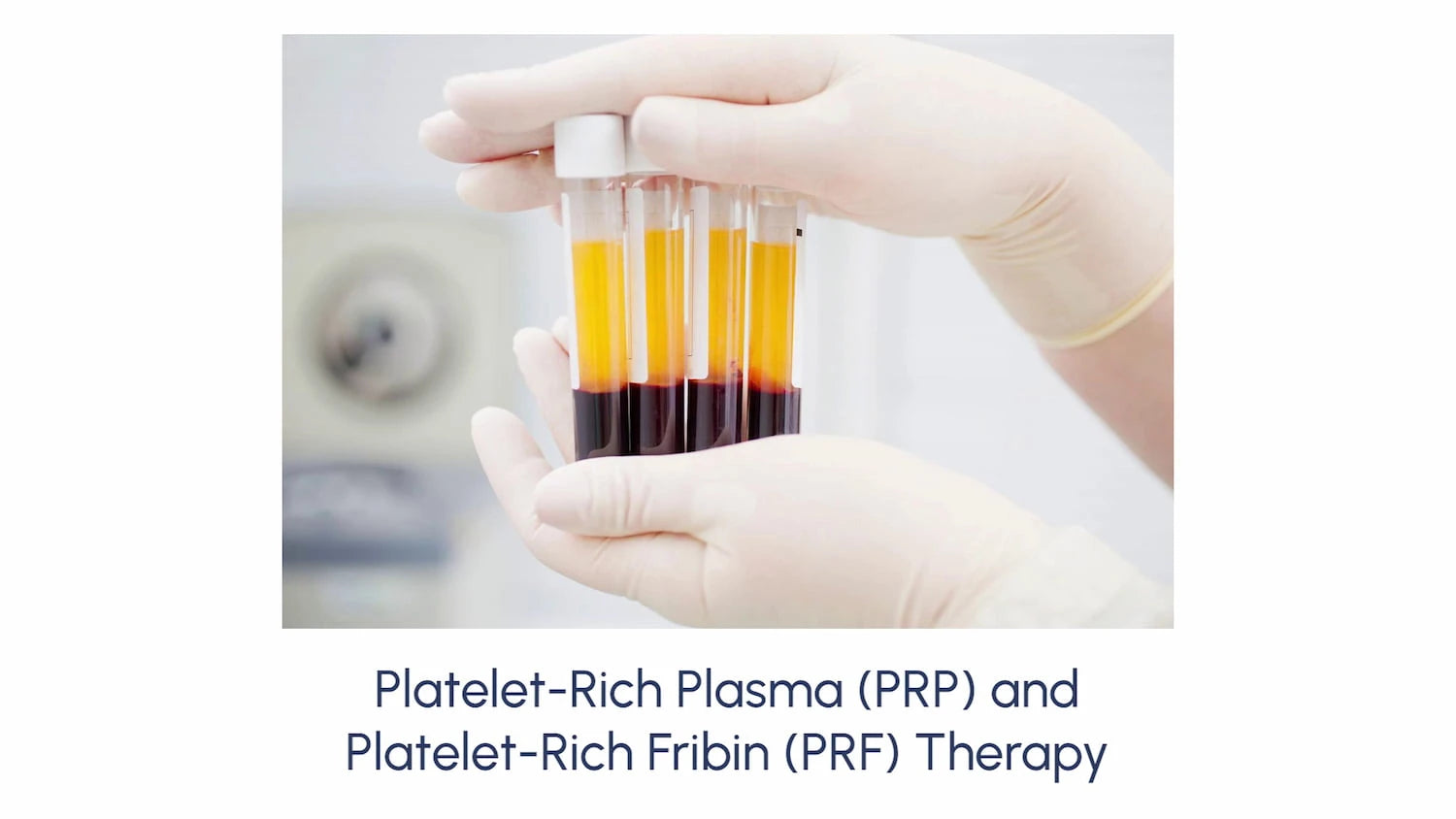 Platelet-Rich Plasma (PRP) And Platelet-Rich Fribin (PRF) Therapy