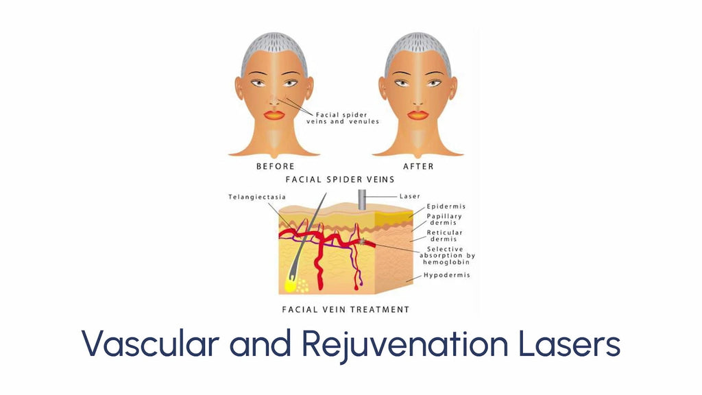 Vascular and Rejuvenation Lasers